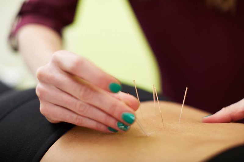 Acupuncture in Downtown Vancouver Sitka Physio & Wellness